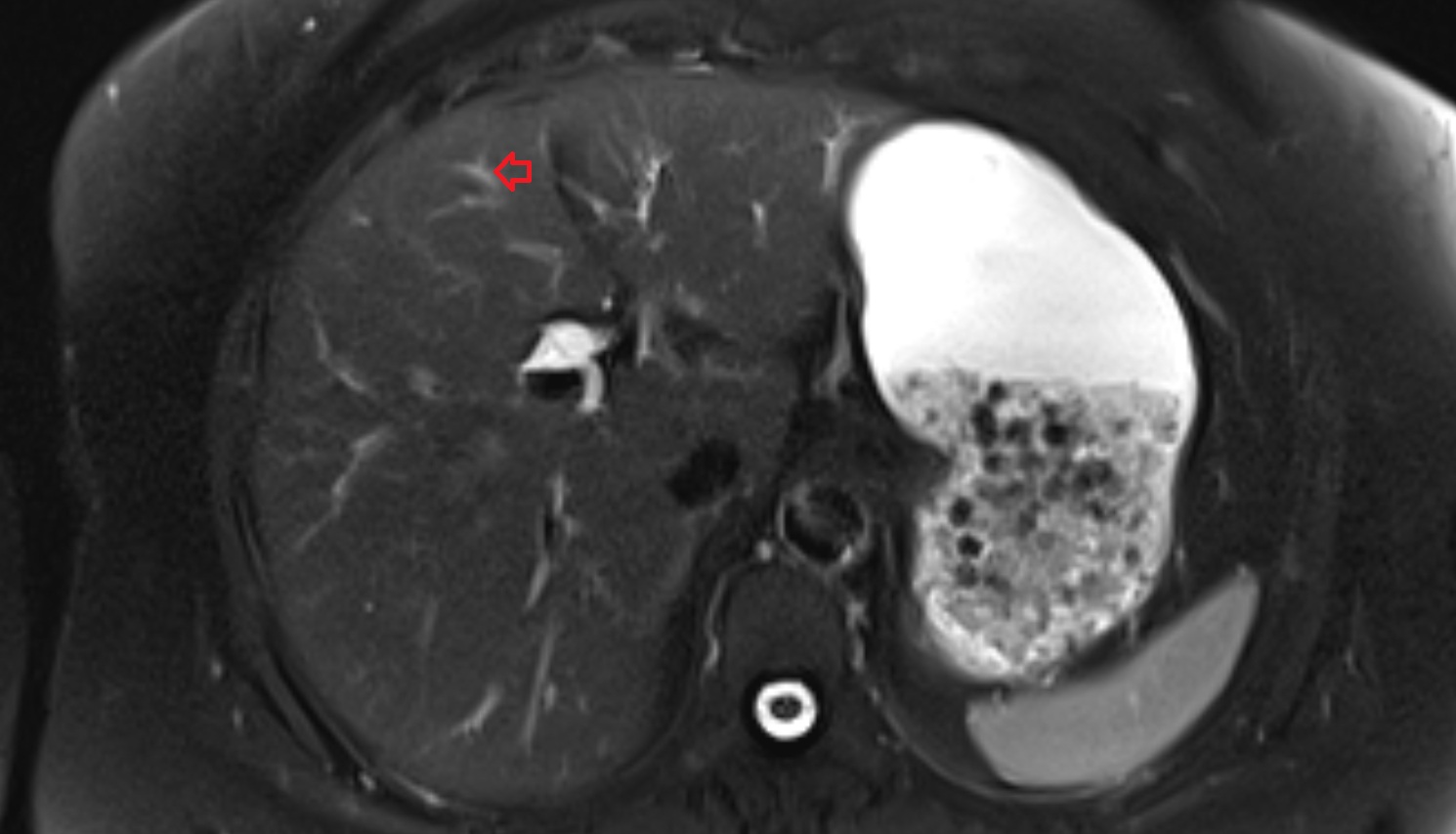 Bile duct serving liver segment IVb  MRI axial  anatomy image-img-00000-00000