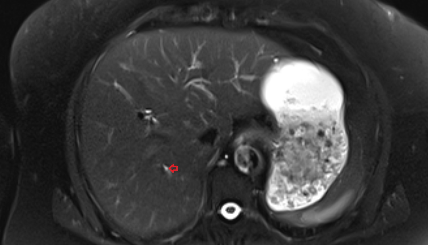 Bile duct serving liver segment VII  MRI axial  anatomy image-img-00000-00000