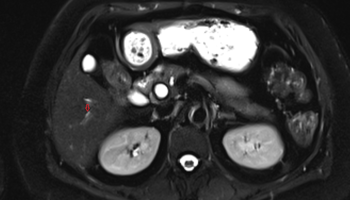 Bile duct serving liver segment VI  MRI axial  anatomy image-img-00000-00000