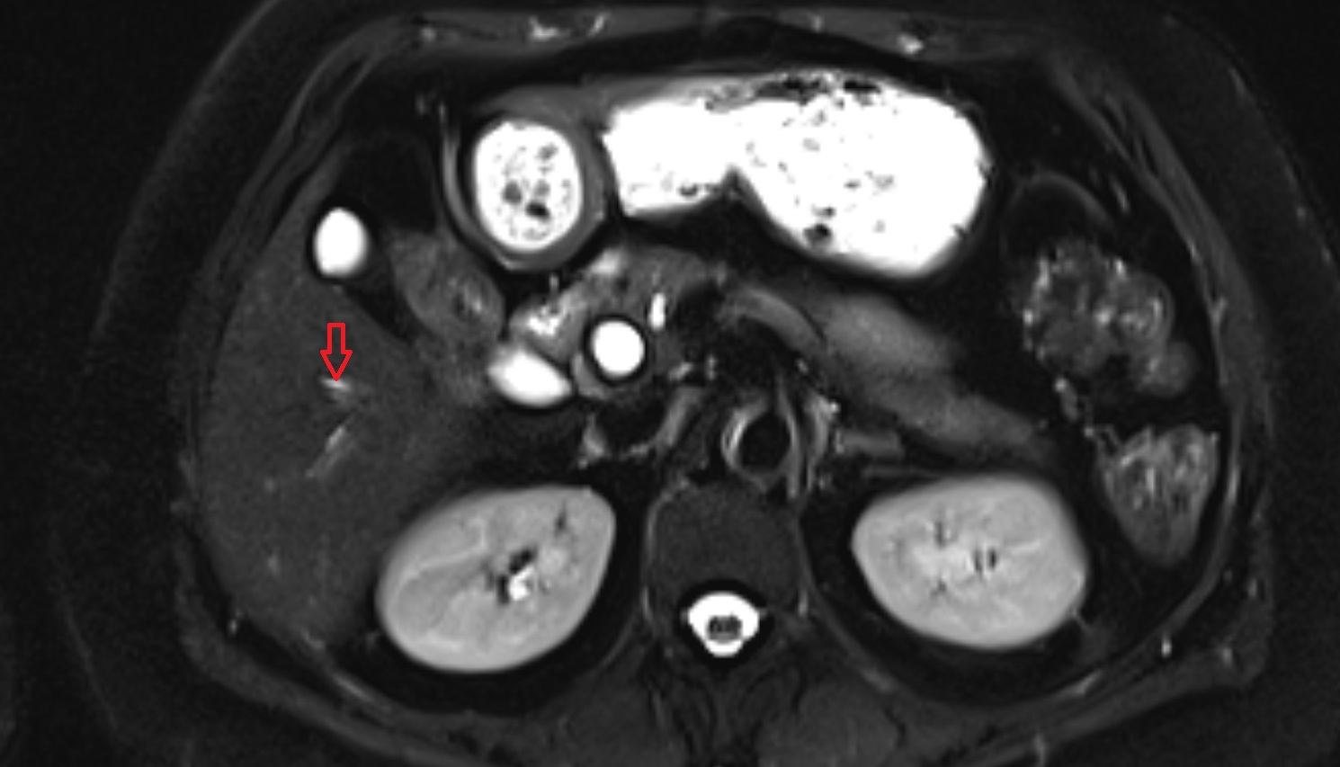 Bile duct serving liver segment V  MRI axial  anatomy image-img-00000-00000