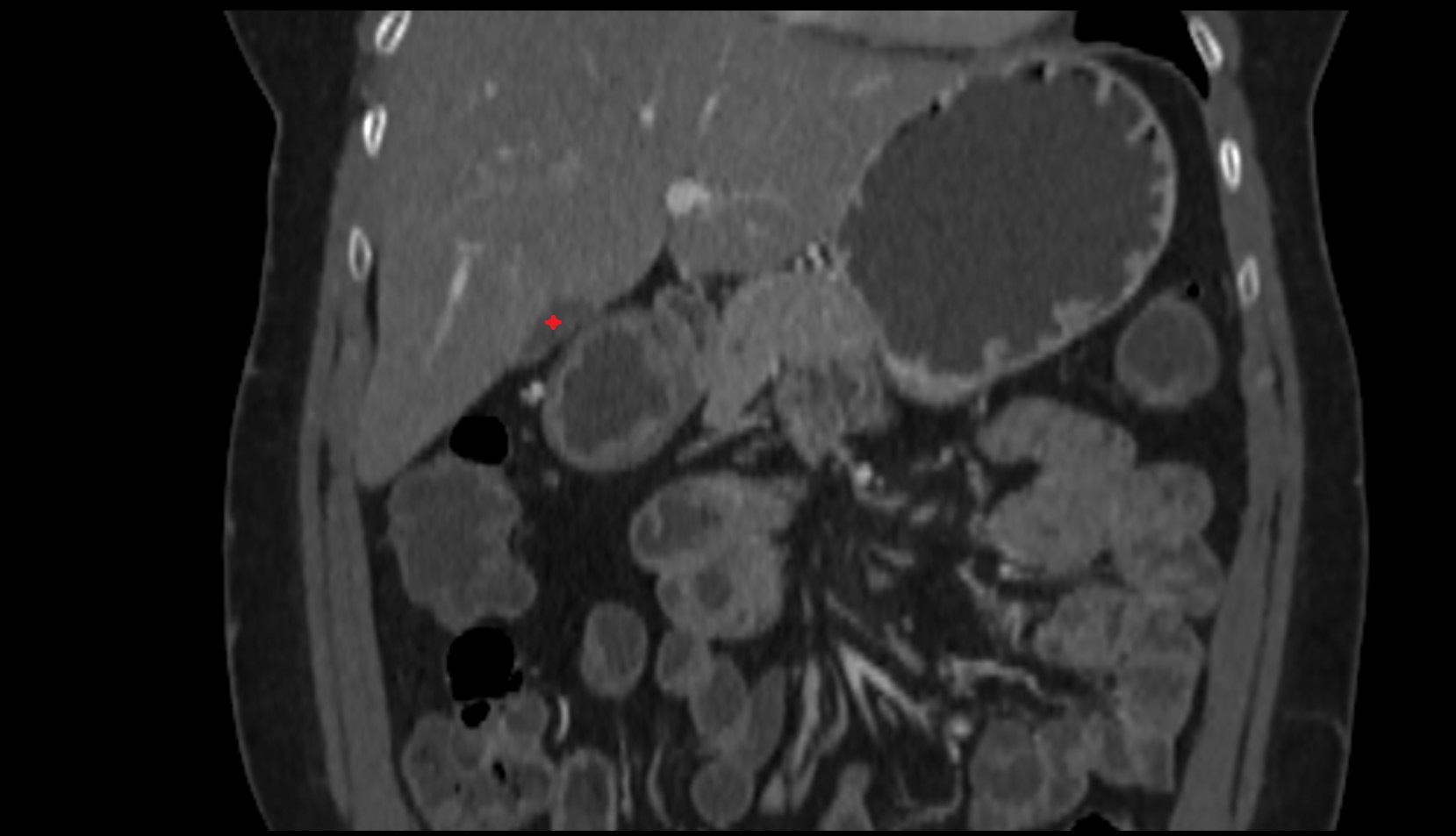 Body of Gallbladder CT coronal anatomy