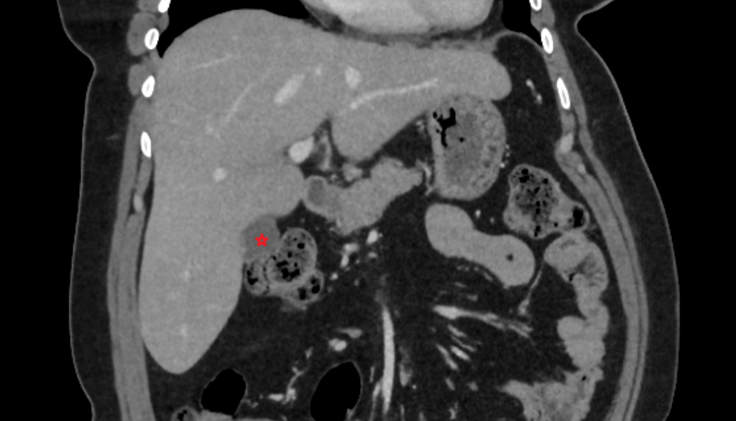 Body of Gallbladder  CT coronal  anatomy  image -img-00000-00000