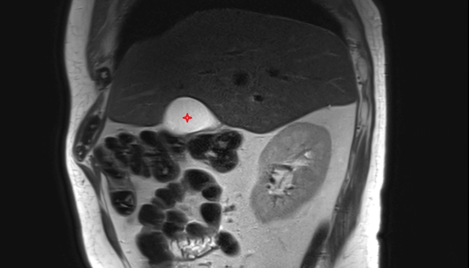 Body of Gallbladder  MRI sag  anatomy  image -img-00000-00000