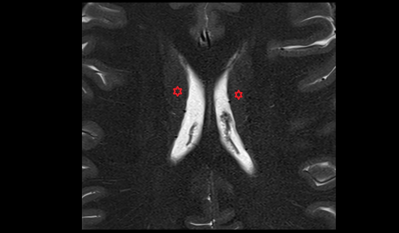 Body of caudate nucleus mri 3t axial image