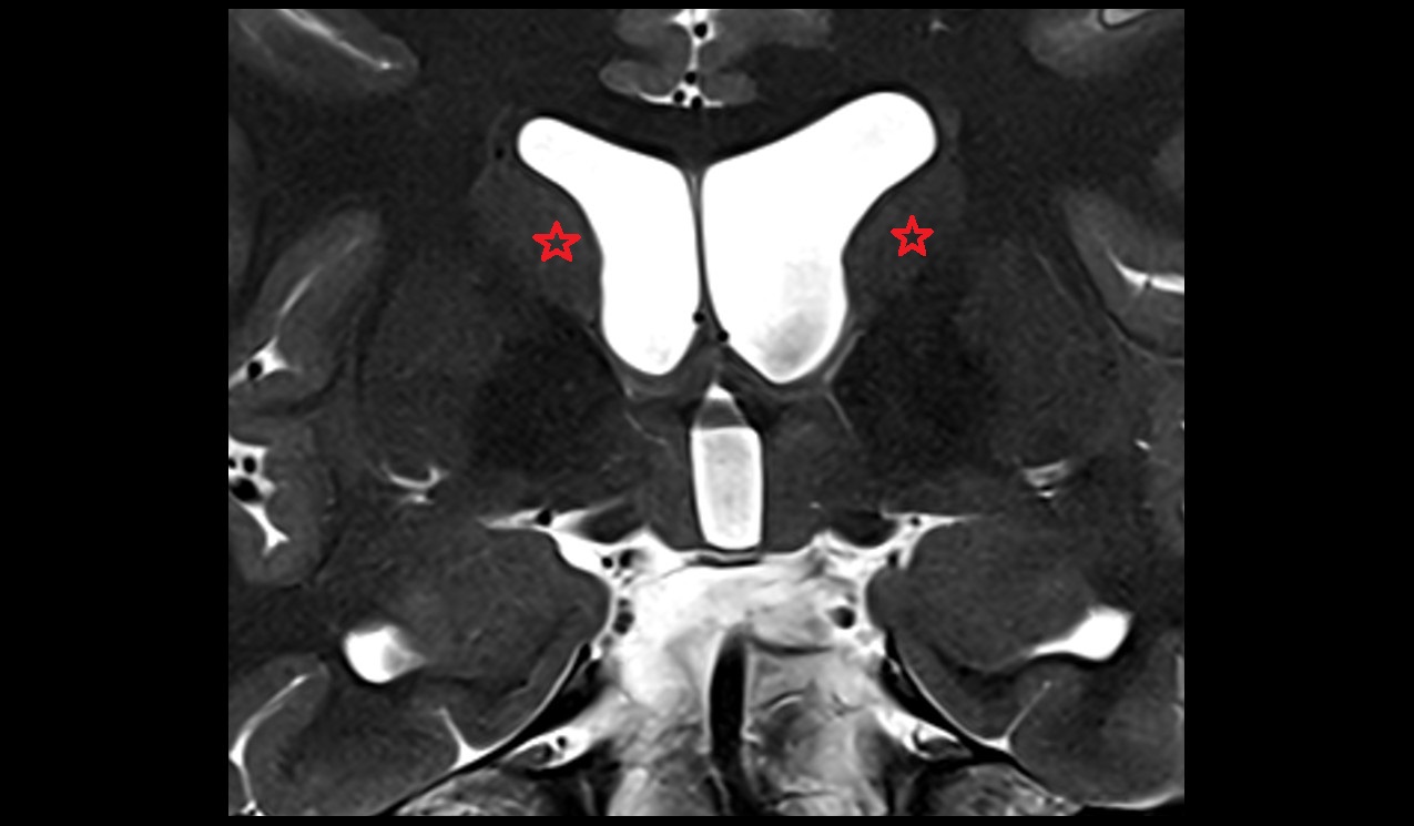 Body of caudate nucleus mri 3t coronal image