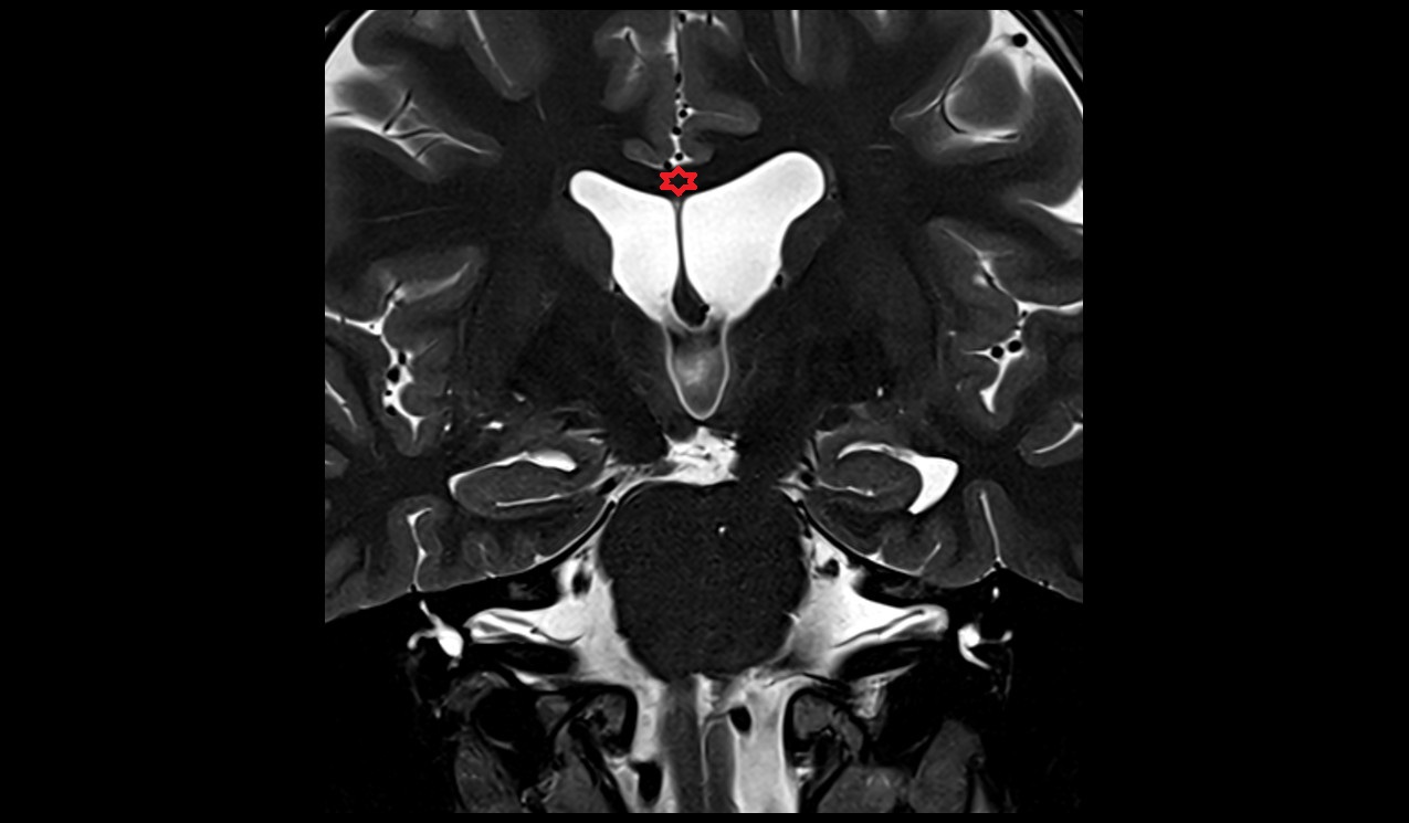 Body of corpus callosum mri 3t coronal image