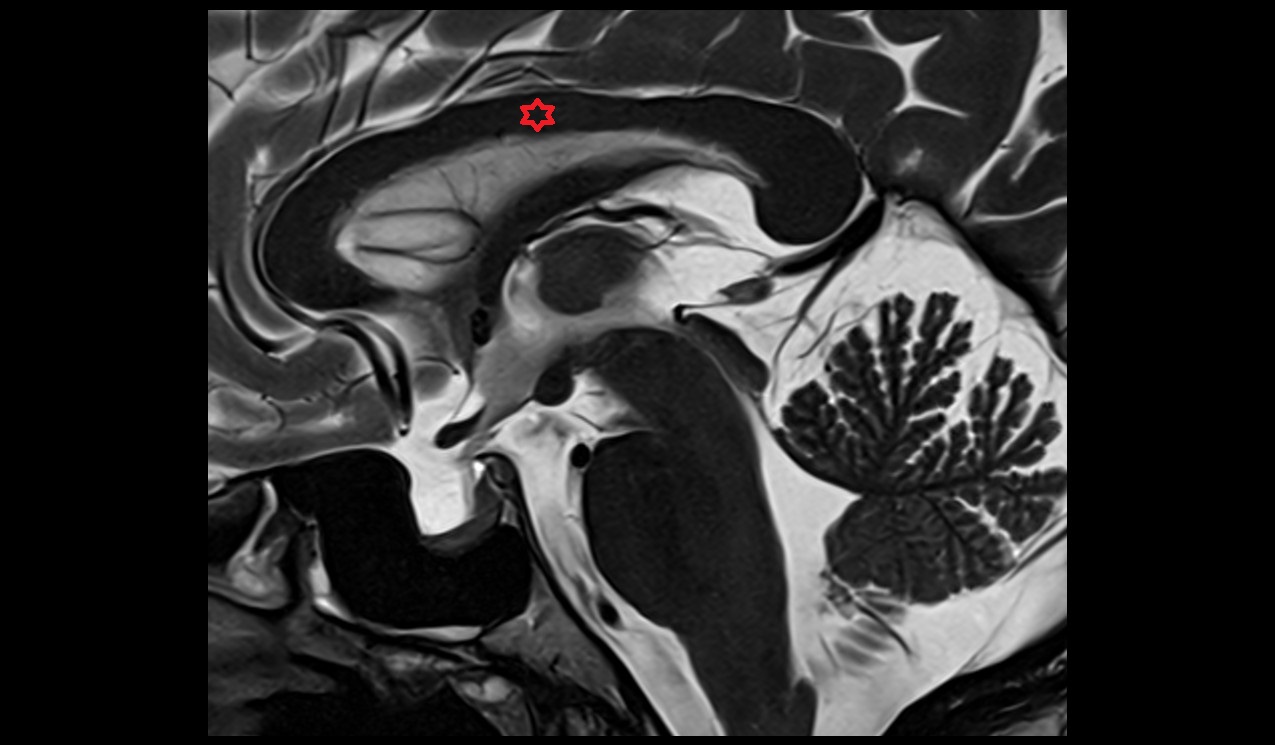 Body of corpus callosum mri 3t sagittal image