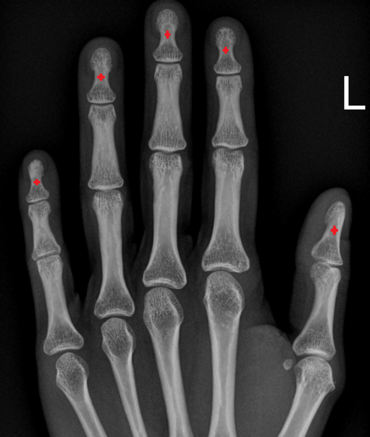 Body of distal phalanx