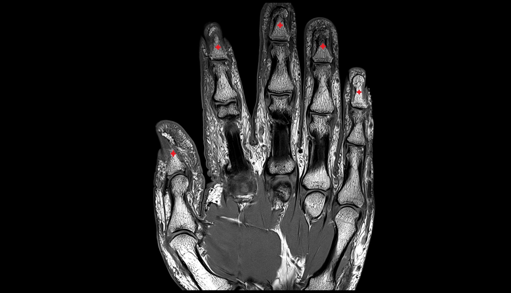 Body of distal phalanx mri image
