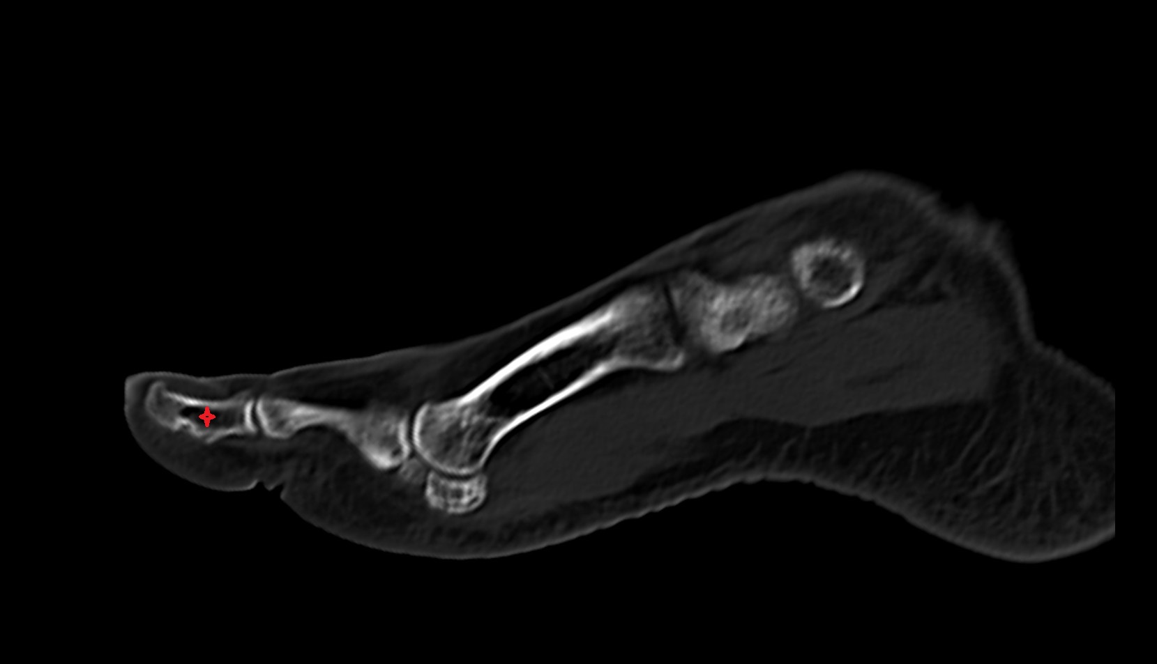 Body of distal phalanx of great toe ct