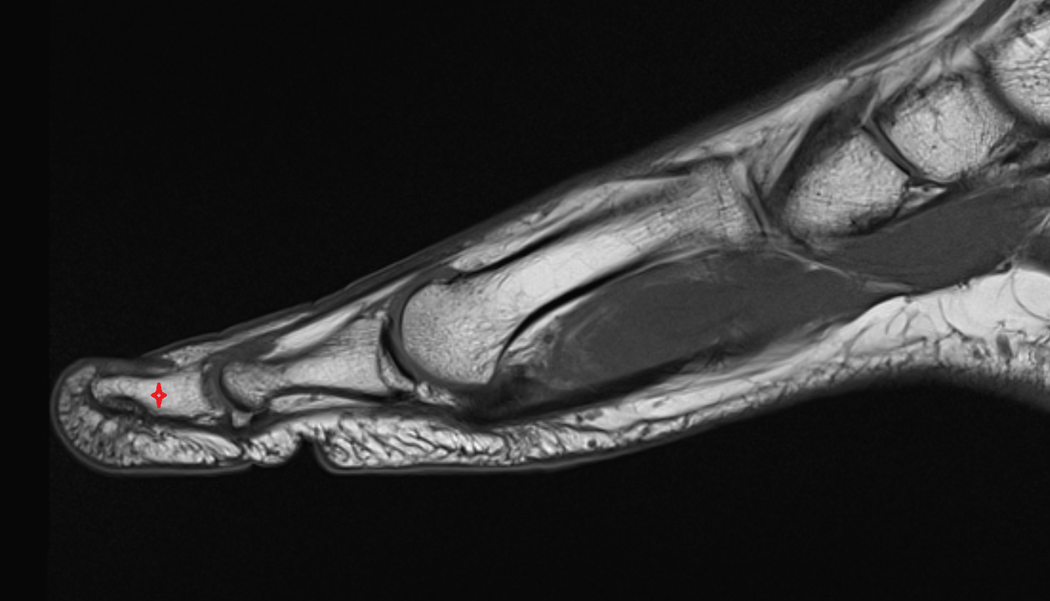 Body of distal phalanx of great toe mri  anatomy labelled image-img-00000-00000