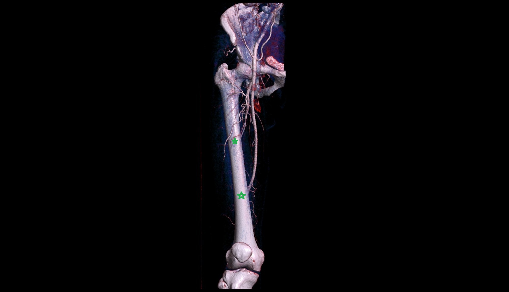 Body of femur 3D IMAGE
