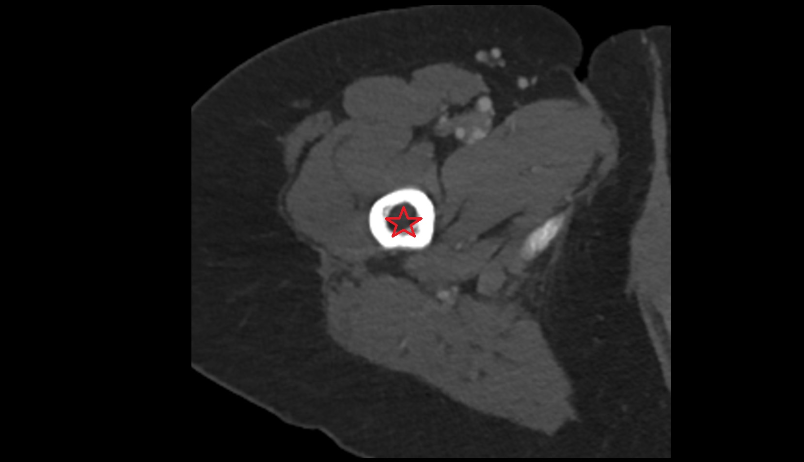 Body of femur AXIAL CT IMAGE