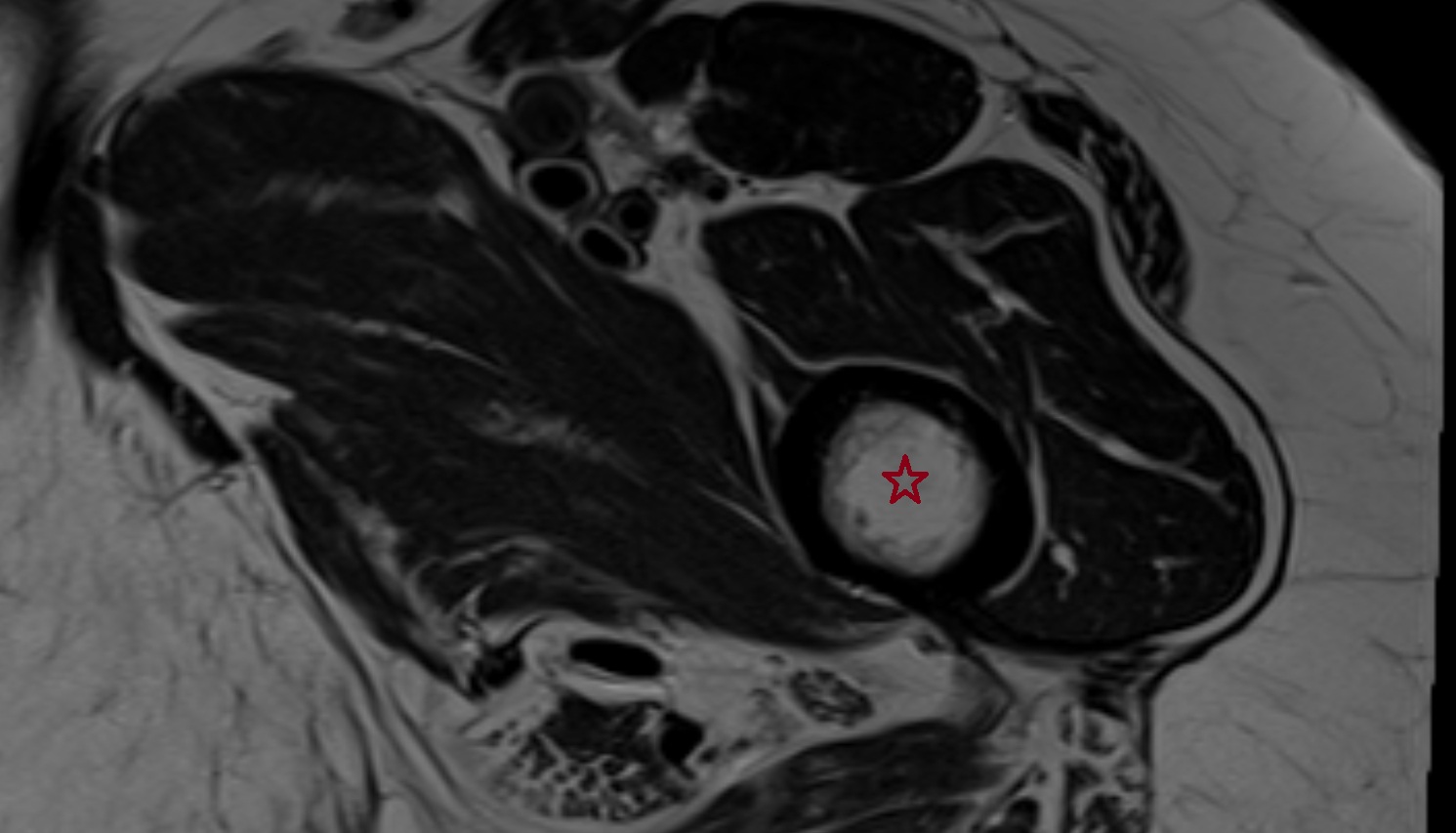 Body of femur  MRI  axial  anatomy  image-img-00000-00000