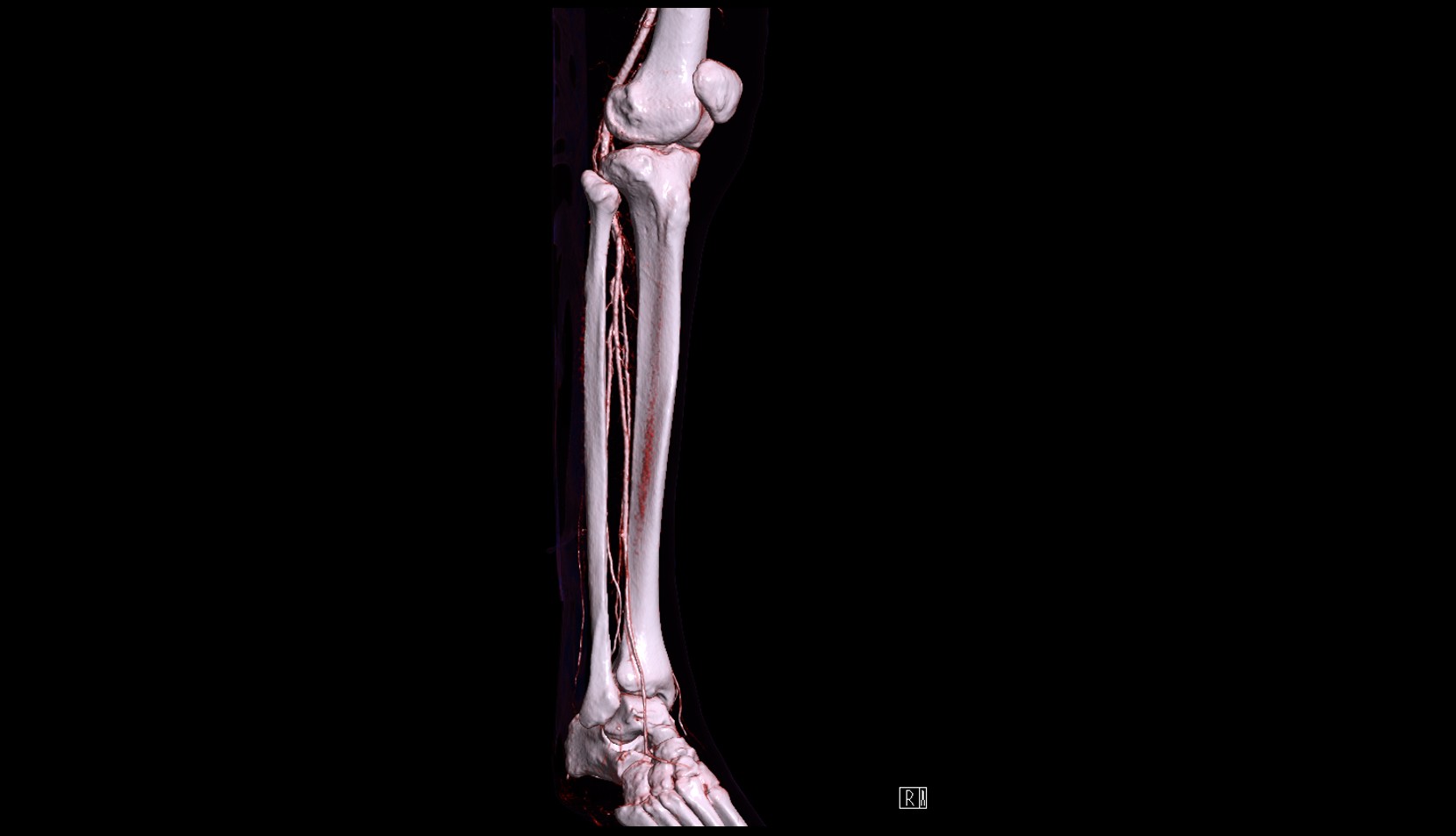 Body of fibula 3d