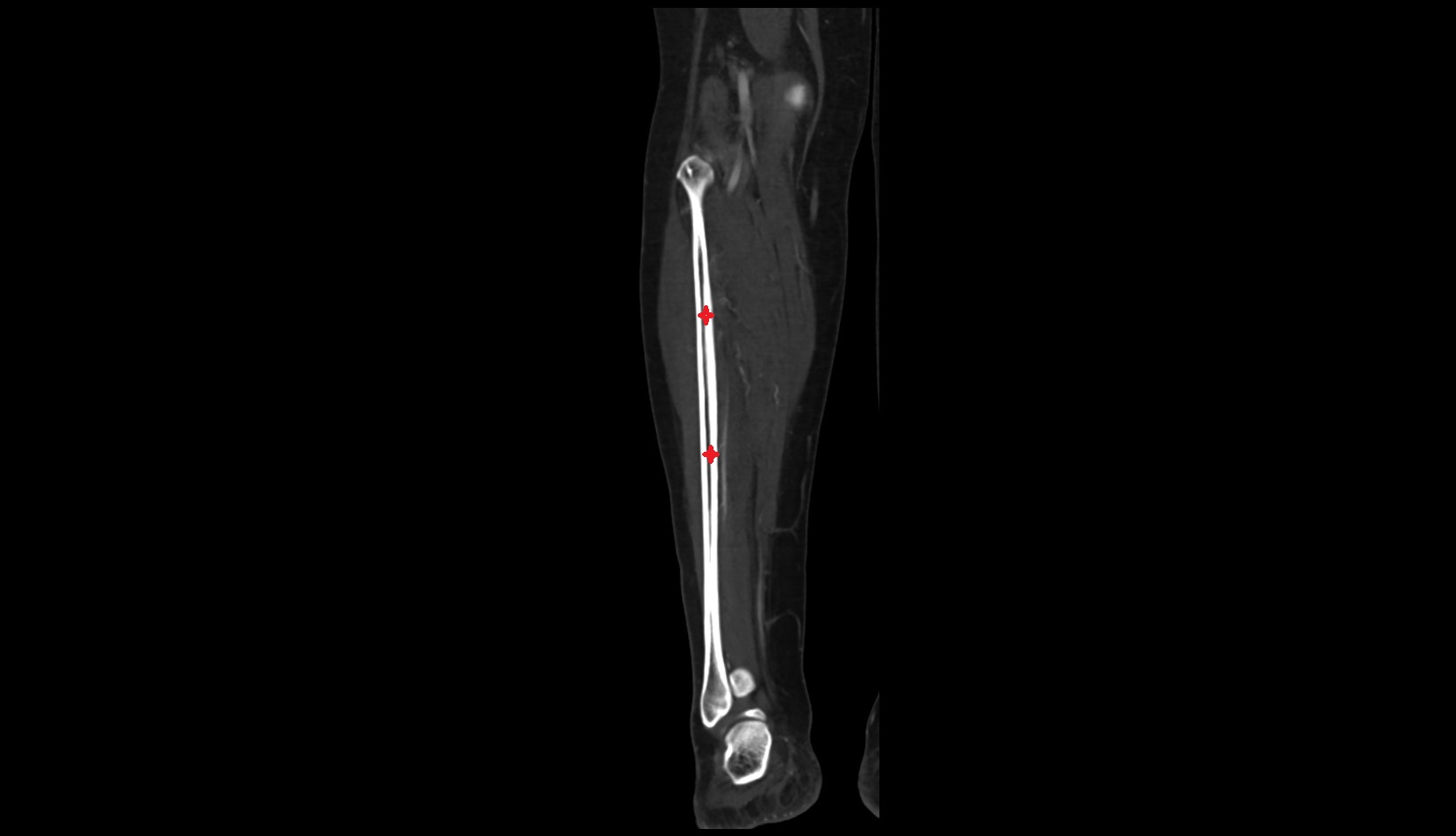 Body of fibula ct coronal