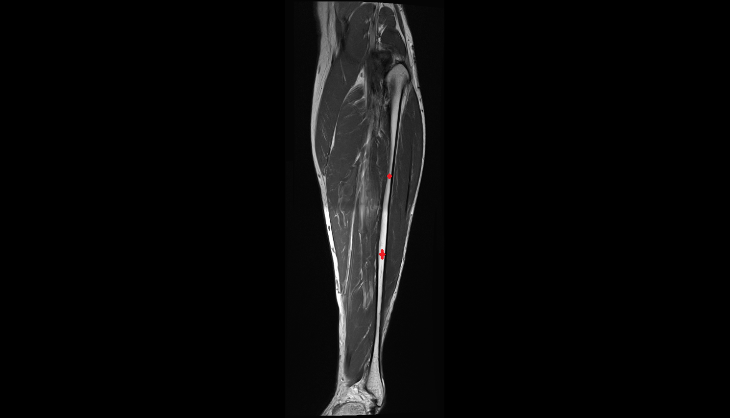 Body of fibula mri  anatomy labelled image-img-00000-00000