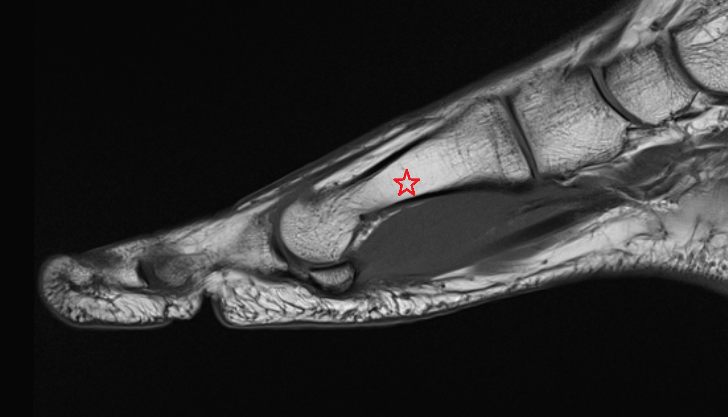 Body of first metatarsal bone mri  anatomy labelled image-img-00000-00000