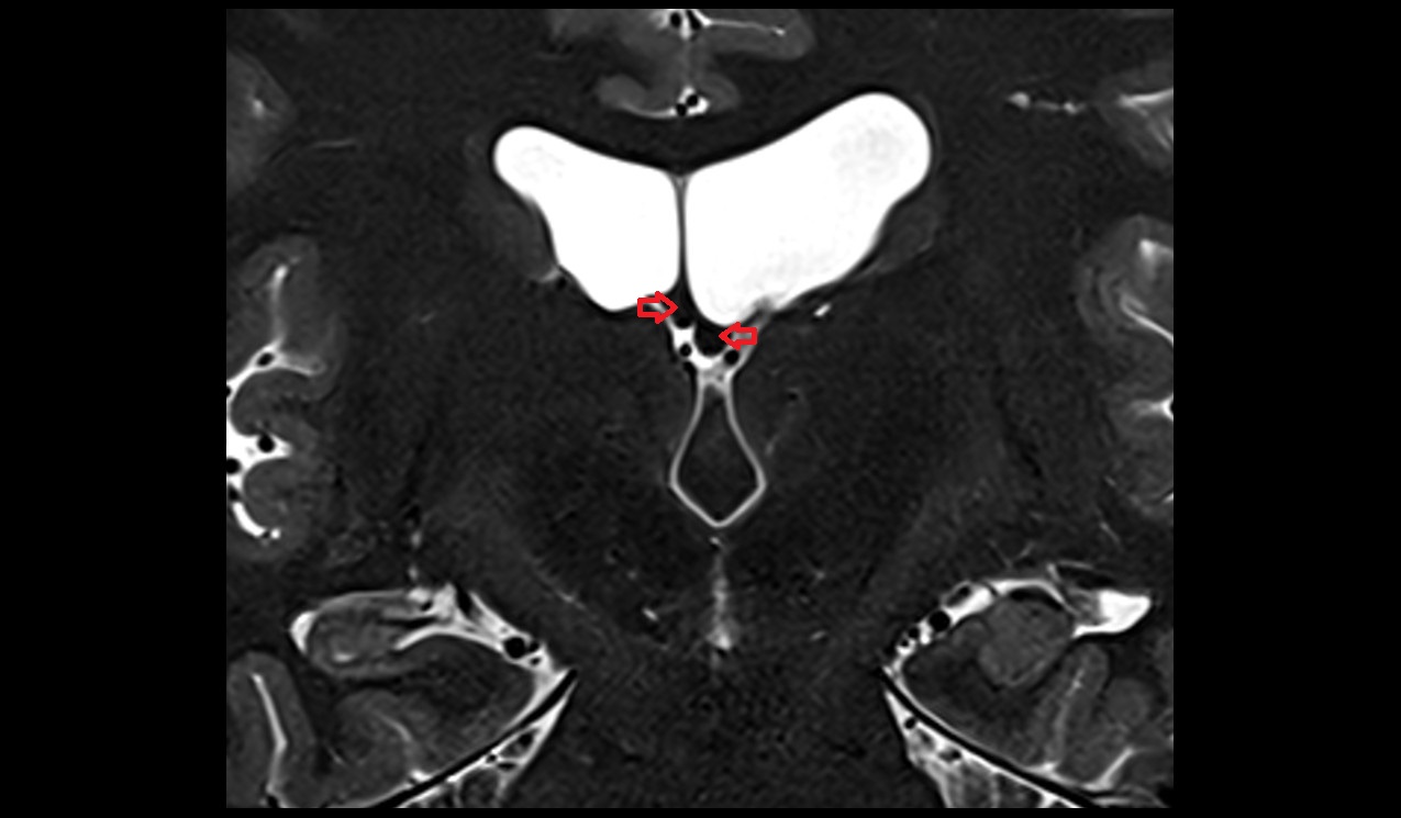 Body of fornix mri 3t coronal image
