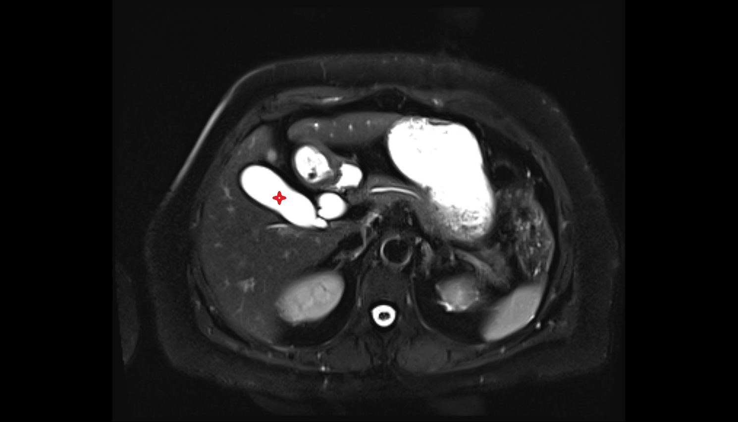Body of gallbladder axial  image-img-00000-00000