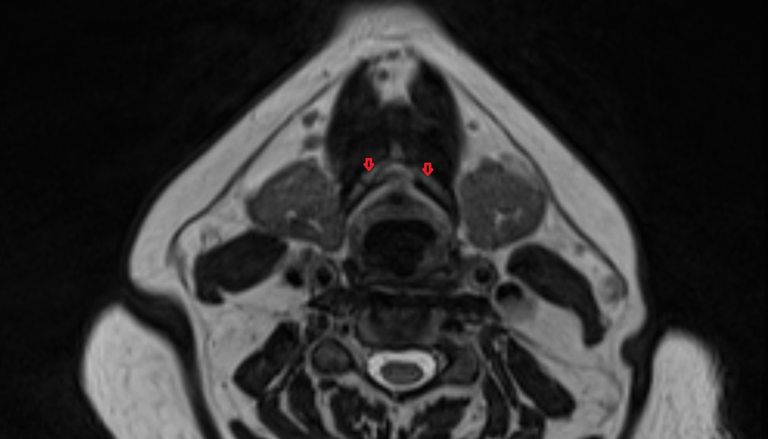 Body of hyoid bone  mri axial image -img-00000-00000