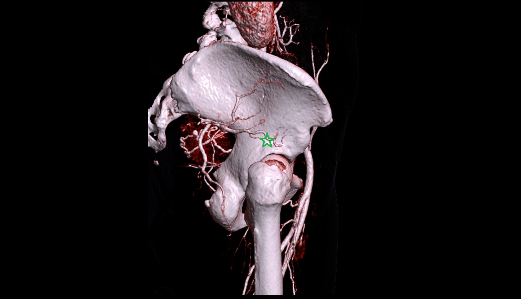 Body of ilium 3 ct image