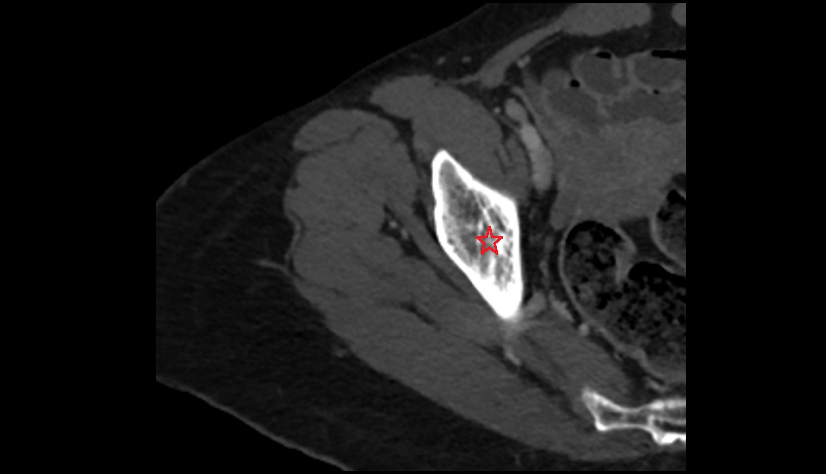 Body of ilium CT axial image