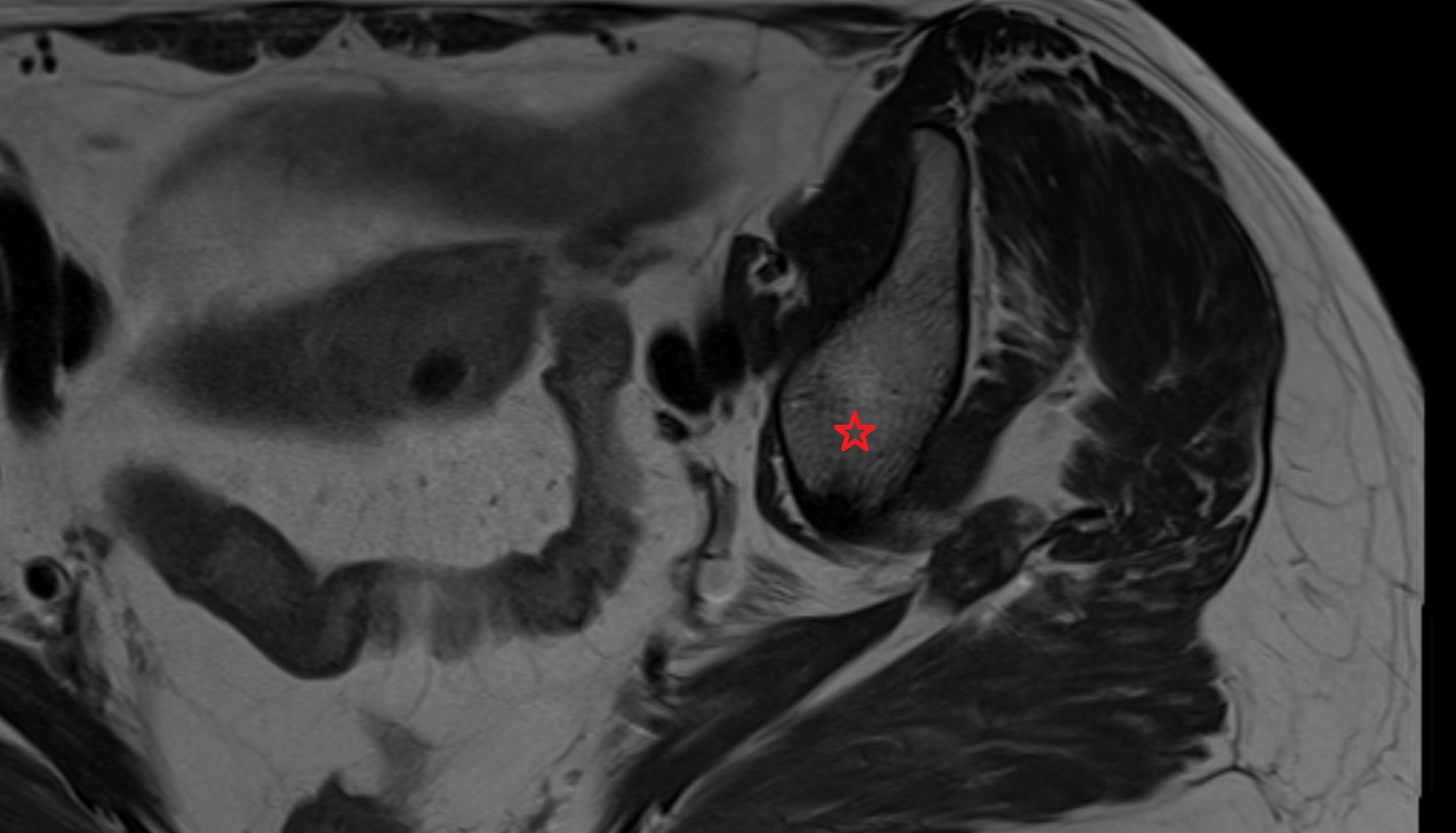 Body of ilium  MRI  axial  anatomy  image-img-00000-00000