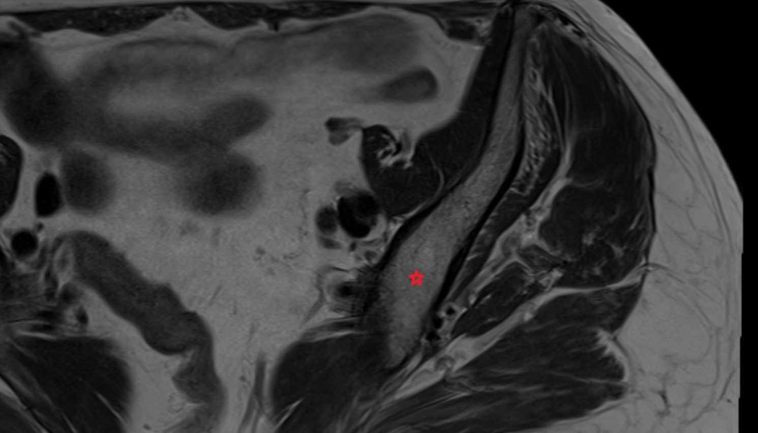 Body of ilium  MRI  axial  anatomy  image-img-00000-00000_00001