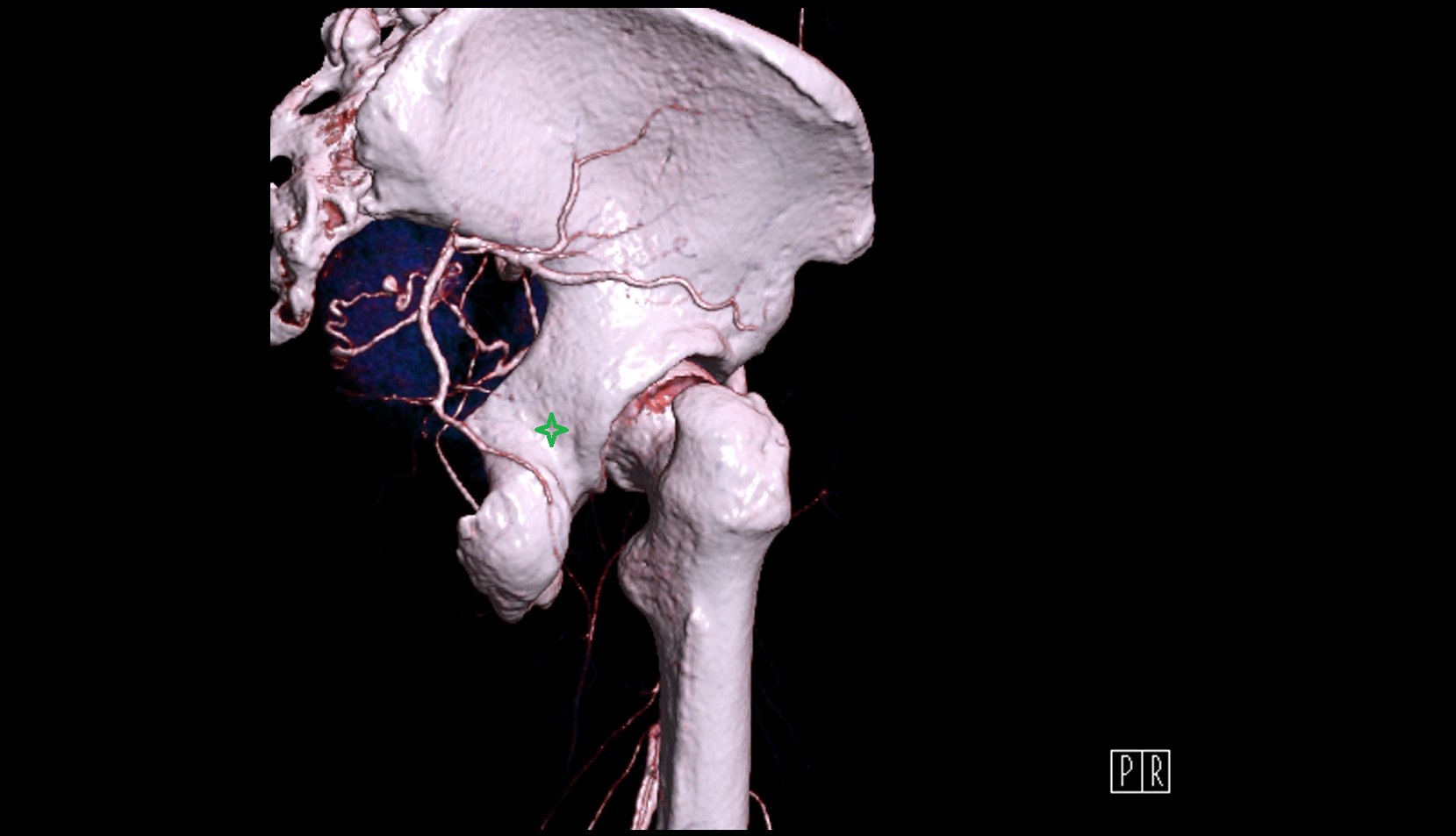 Body of ischium 3D ct vrt image