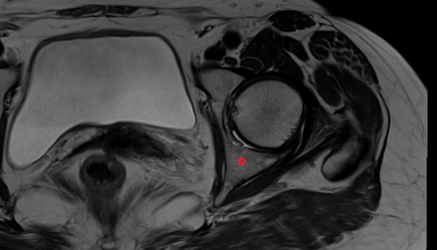 Body of ischium  MRI  axial  anatomy  image-img-00000-00000
