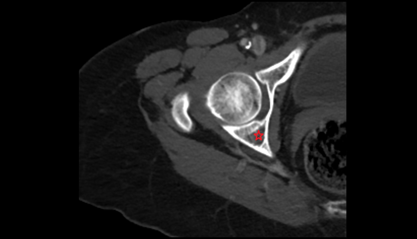 Body of ischium ct axial image