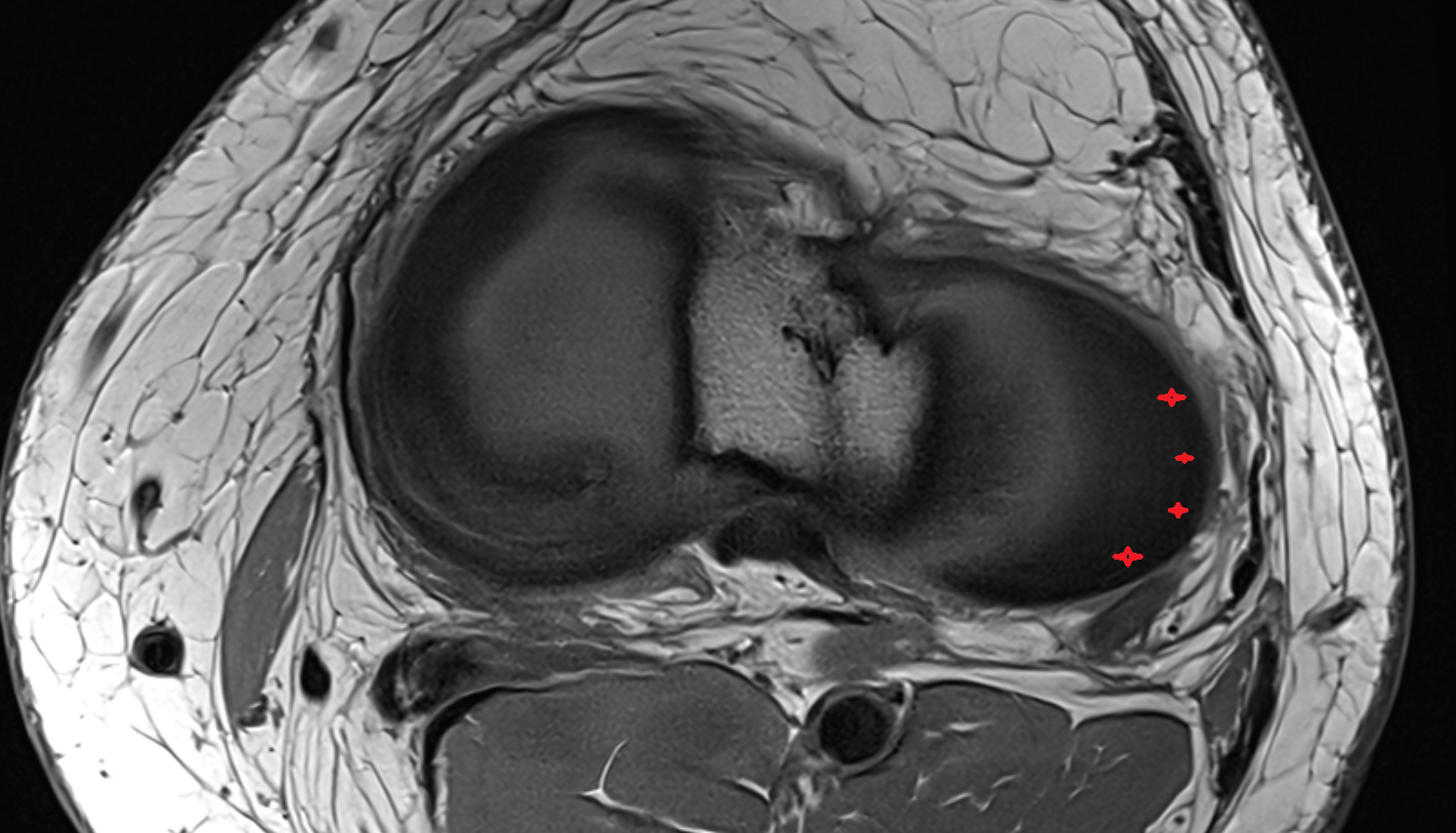 Body of lateral meniscus  axial  cross sectional anatomy 3T MRI AI enhanced  radiology  anatomy image-img-00000-00000