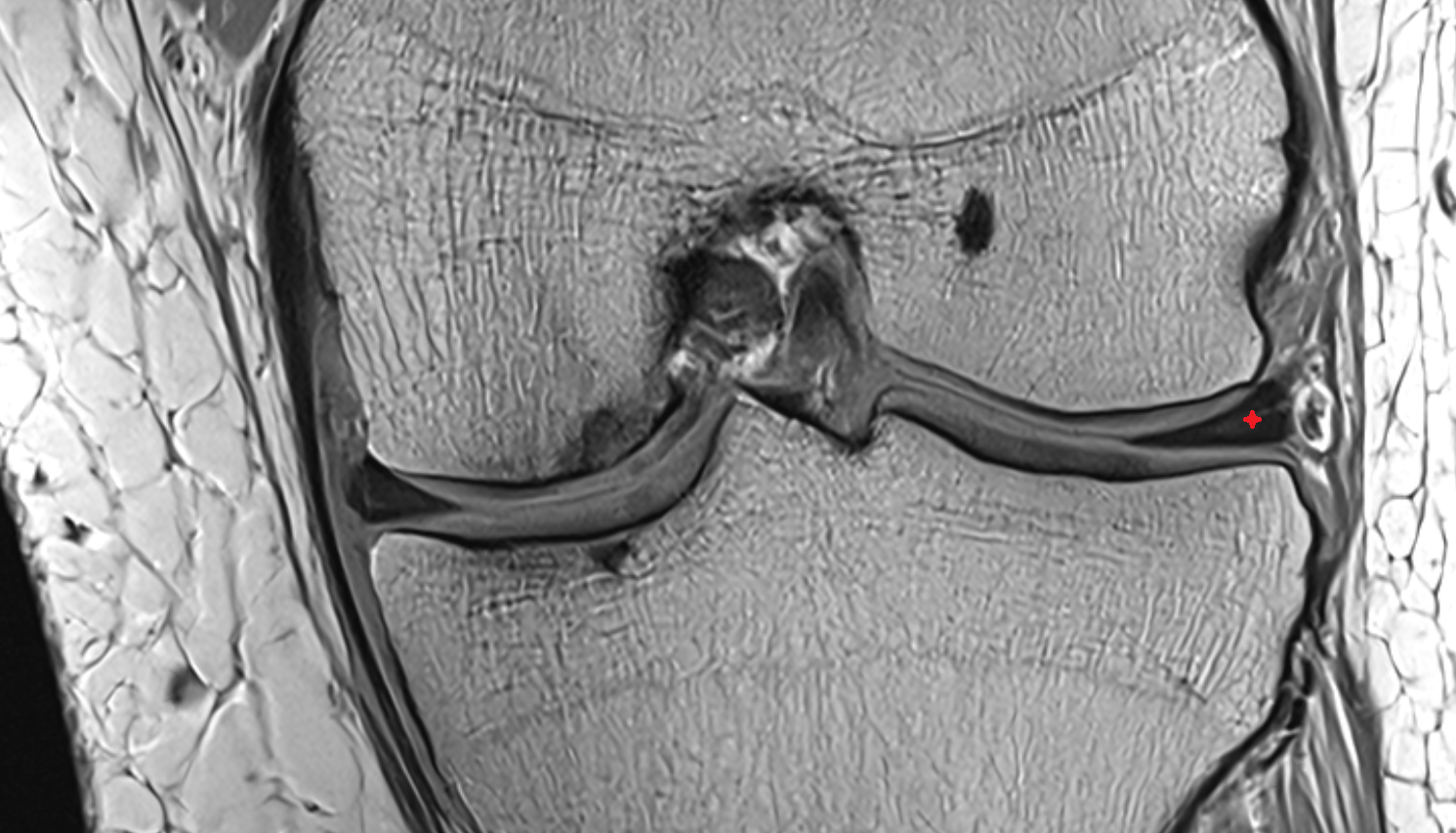 Body of lateral meniscus  coronal  cross sectional anatomy 3T MRI AI enhanced  radiology  anatomy image-img-00000-00000
