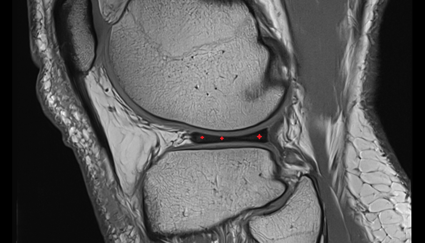 Body of lateral meniscus  sagittal  cross sectional anatomy 3T MRI AI enhanced  radiology  anatomy image-img-00000-00000