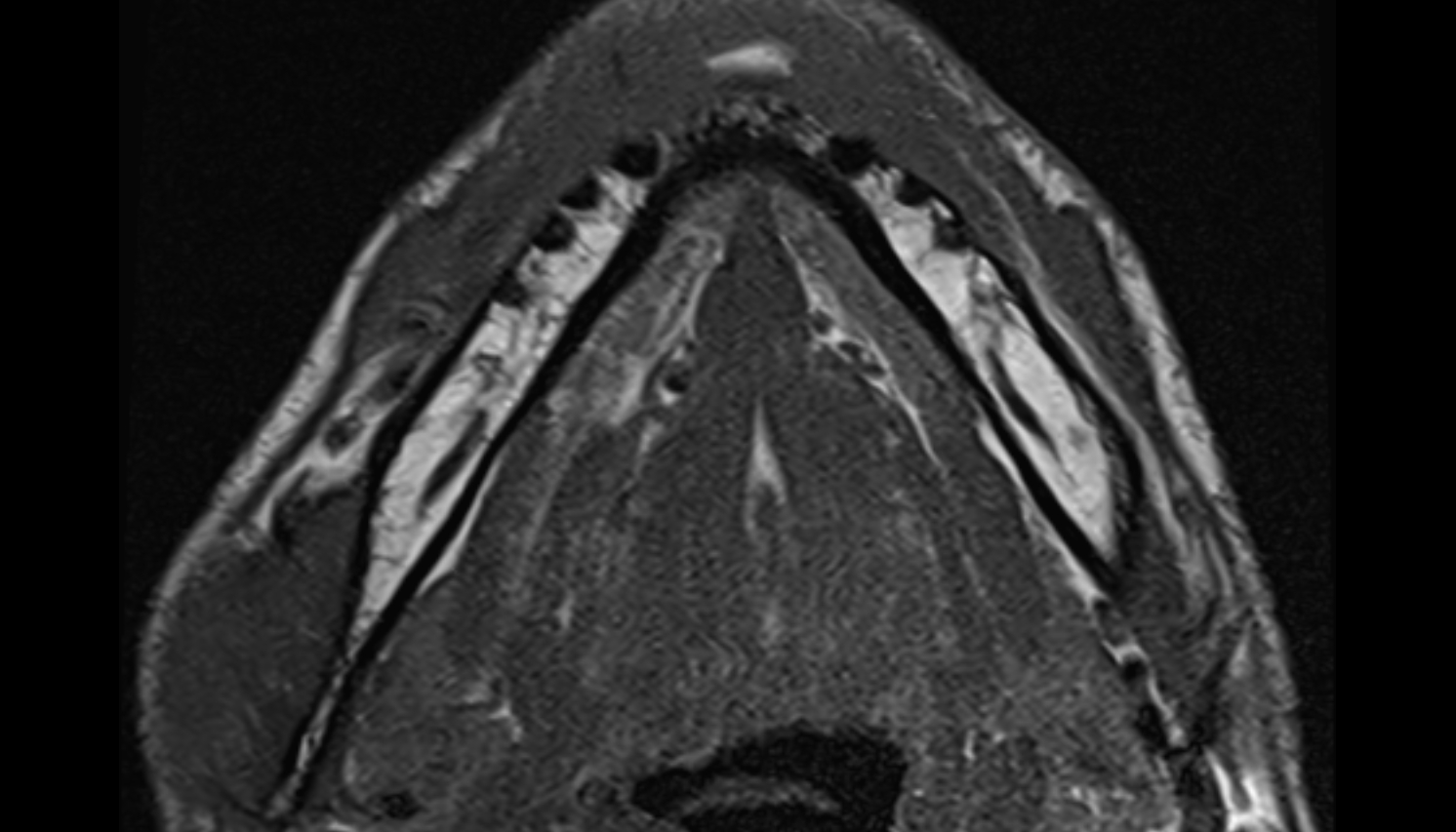 Body of mandible mri axial image -img-00000-00000_00001