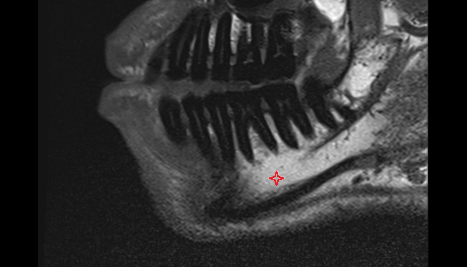 Body of mandible mri sag image 00-00000