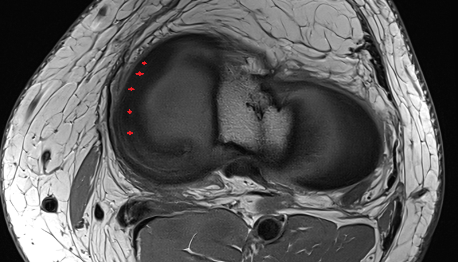 Body of medial meniscus  axial  cross sectional anatomy 3T MRI AI enhanced  radiology  anatomy image-img-00000-00000