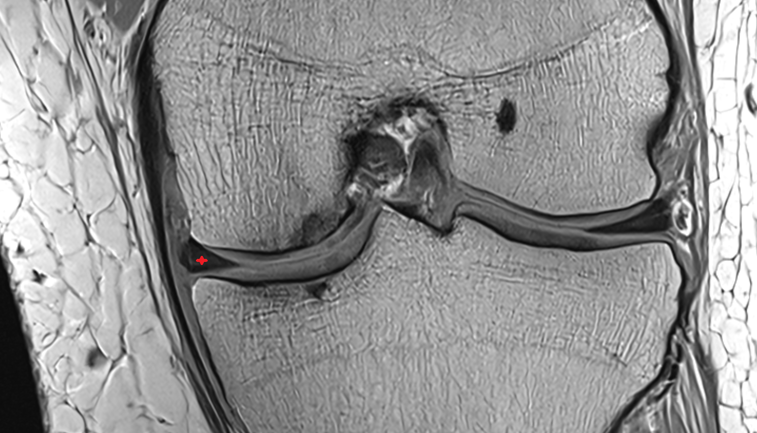 Body of medial meniscus coronal  cross sectional anatomy 3T MRI AI enhanced  radiology  anatomy image-img-00000-00000