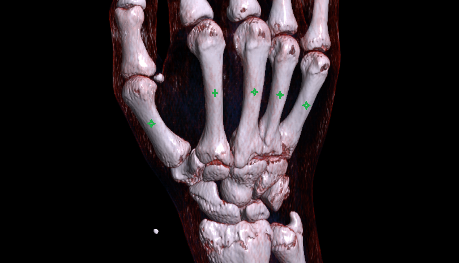 Body of metacarpal bone CT 3D VRT image -img-00000-00000