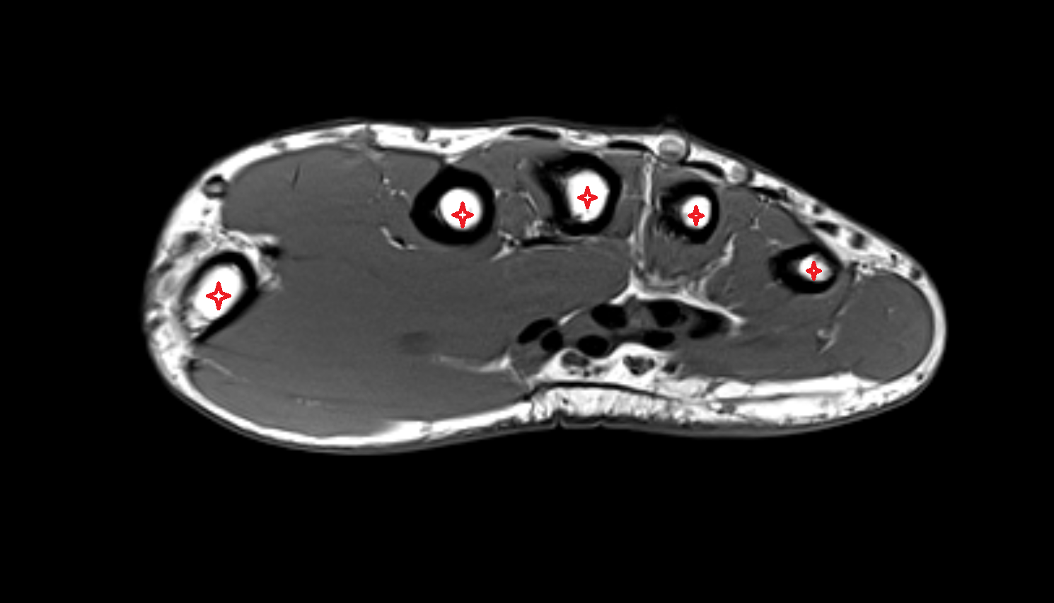 Body of metacarpal bone axial cross sectional anatomy 3T MRI AI enhanced radiology image-img-00000-00000
