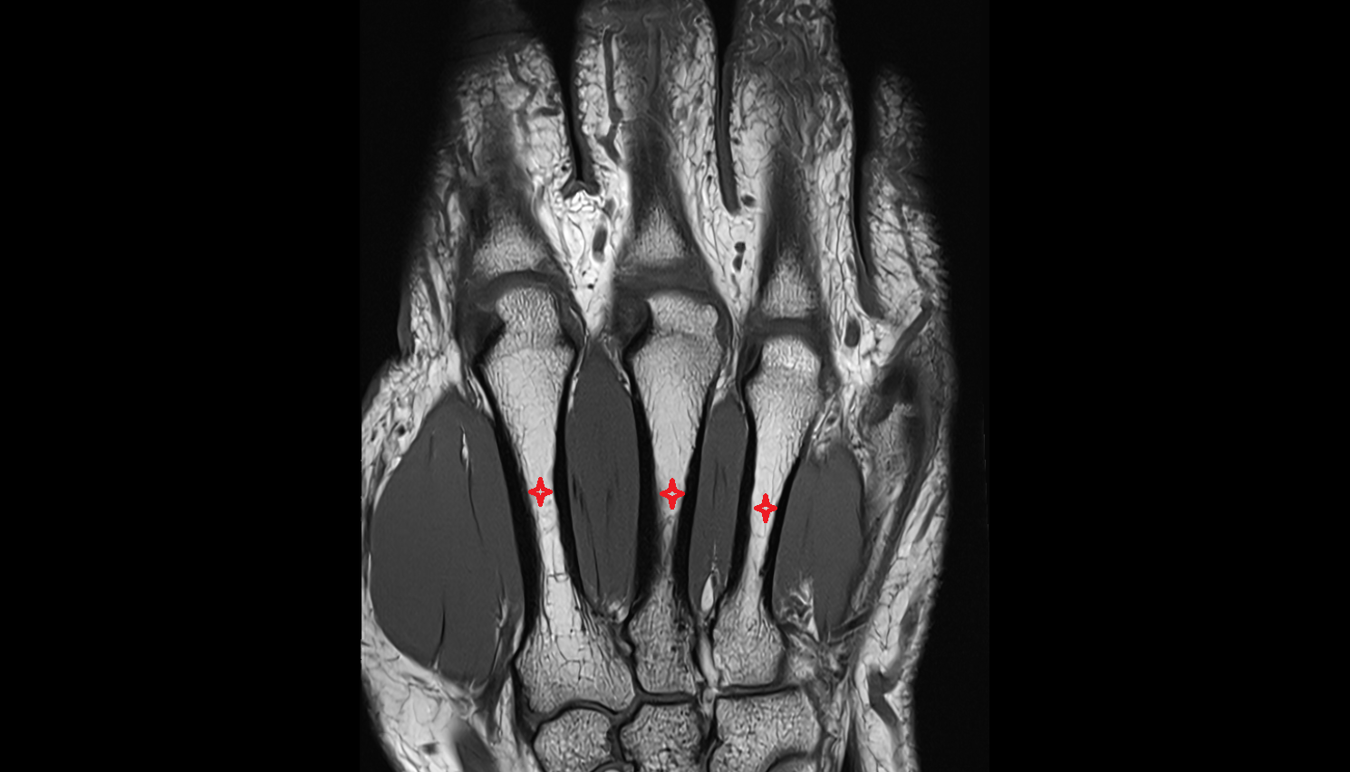 Body of metacarpal bone coronal cross sectional anatomy 3T MRI AI enhanced radiology image-img-00000-00000
