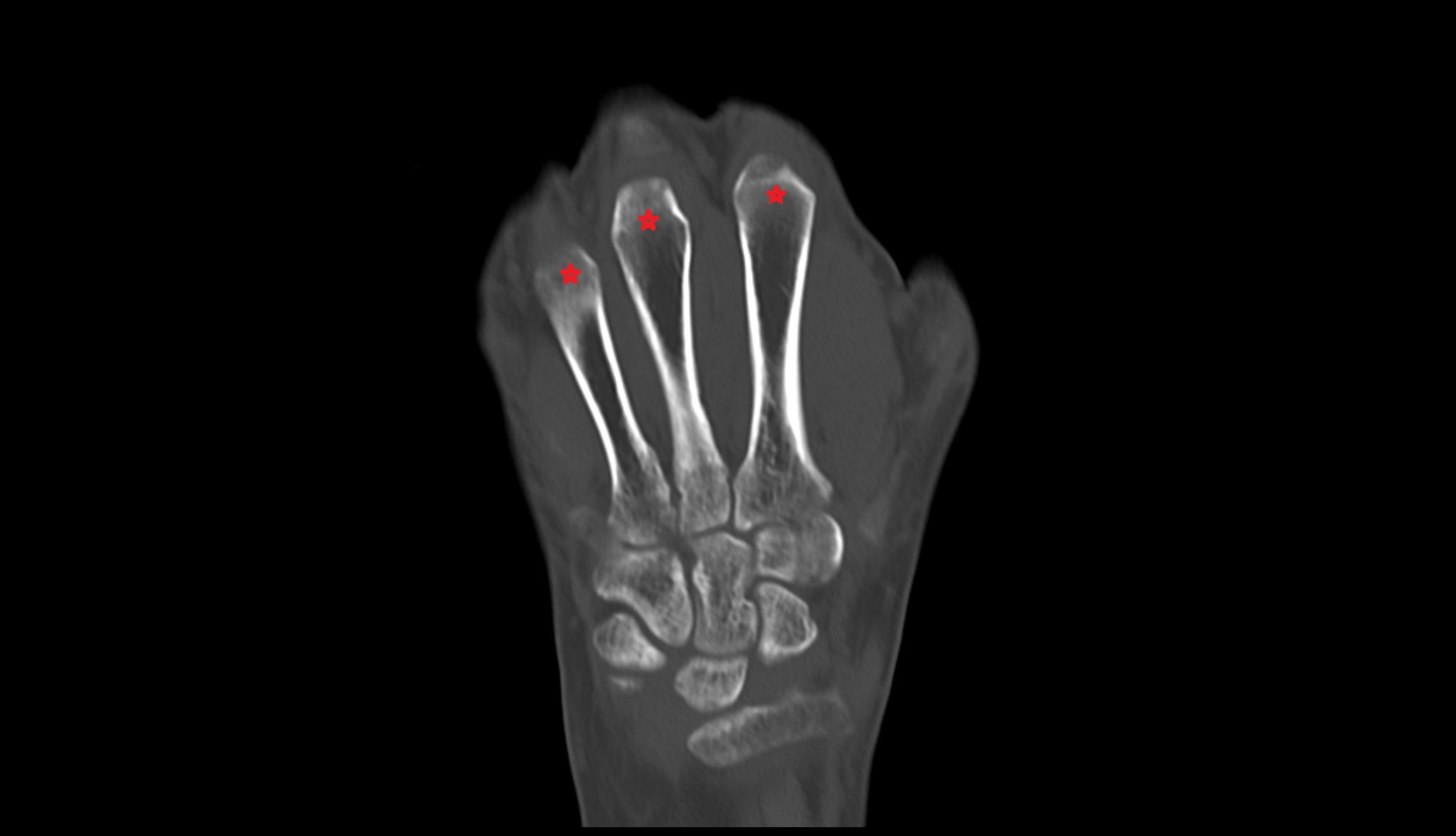 Body of metacarpal bone  ct coronal image