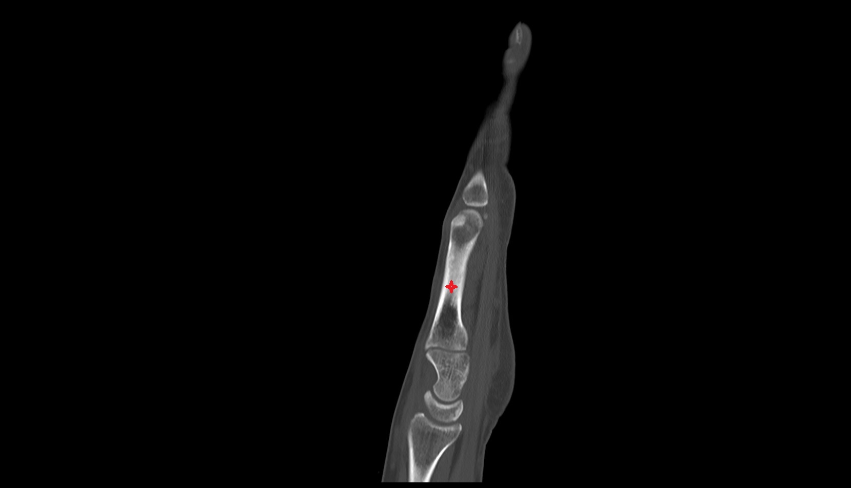 Body of metacarpal bone  ct sag image