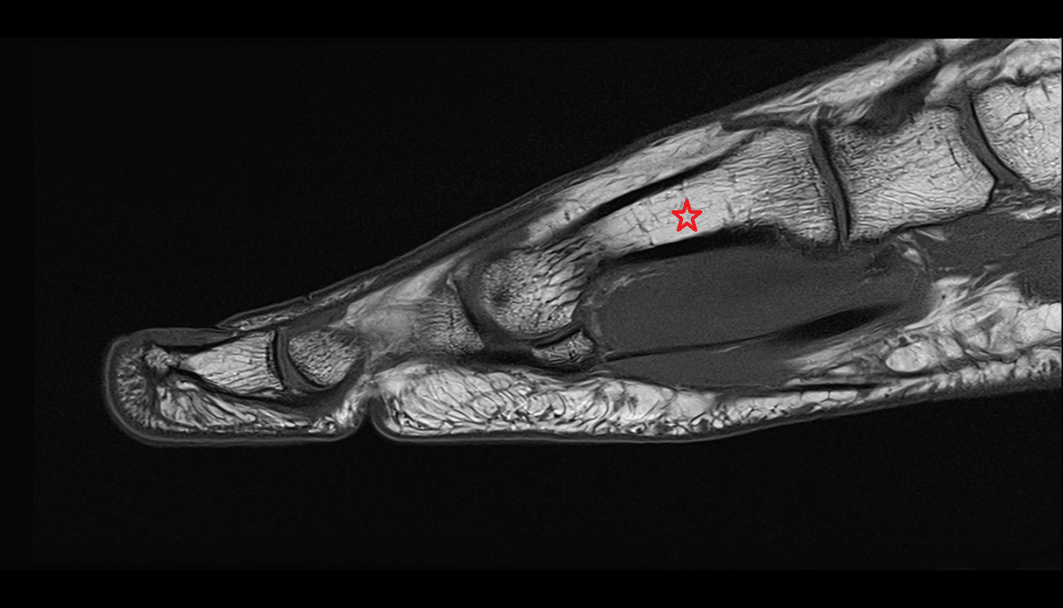 Body of metatarsal bone SAG cross sectional anatomy 3T MRI AI enhanced radiology image-img-00000-00000