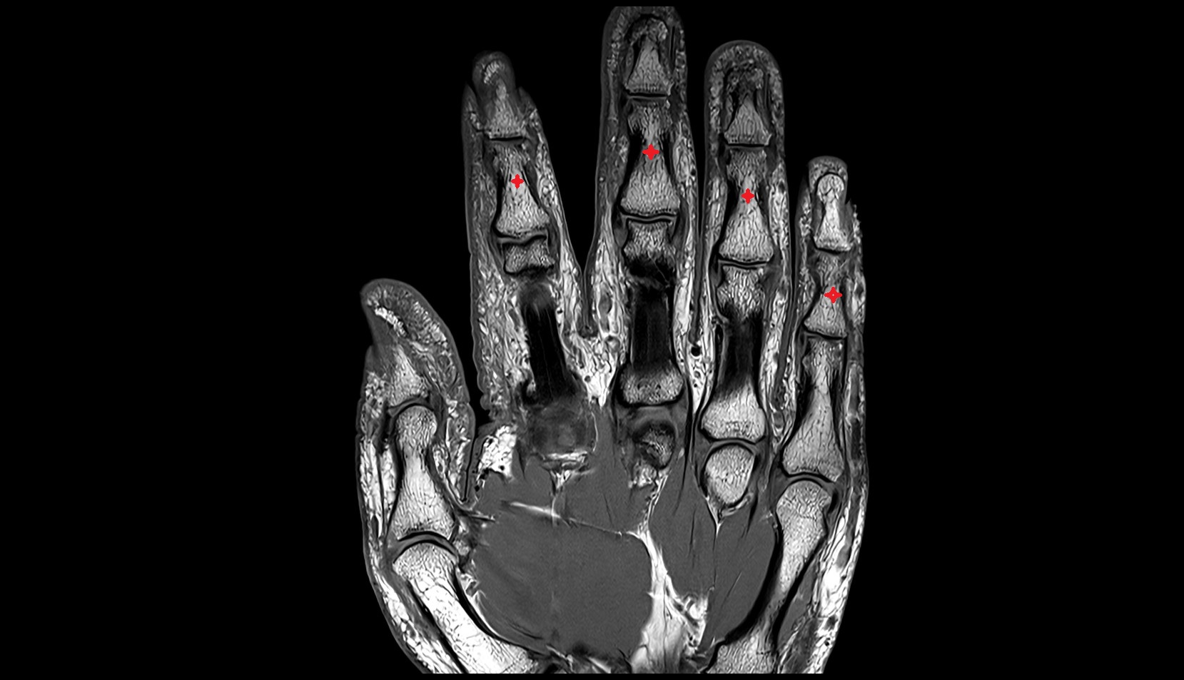 Body of middle phalanx mri image