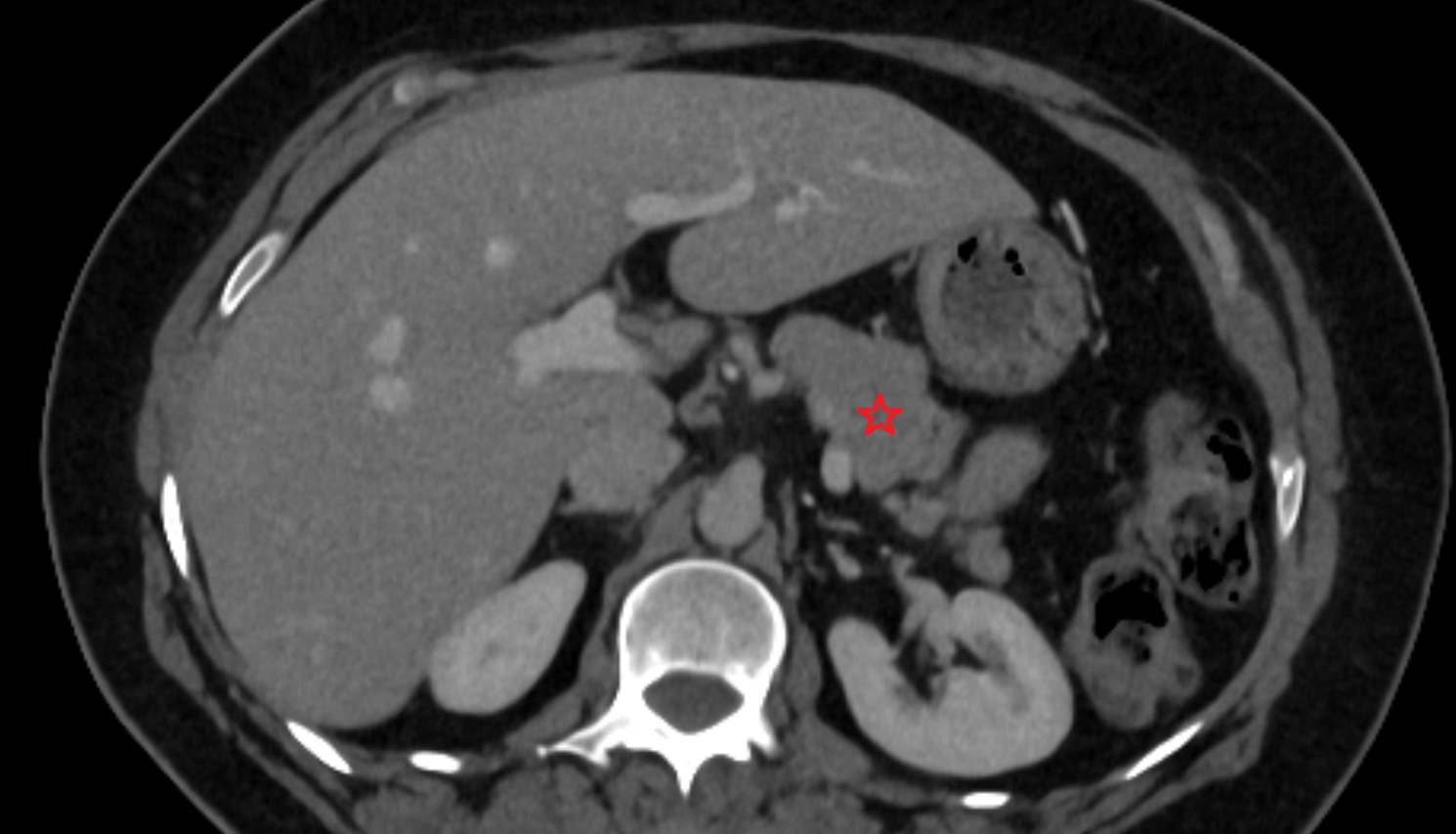 Body of pancreas  CT  axial  anatomy image-img-00000-00000