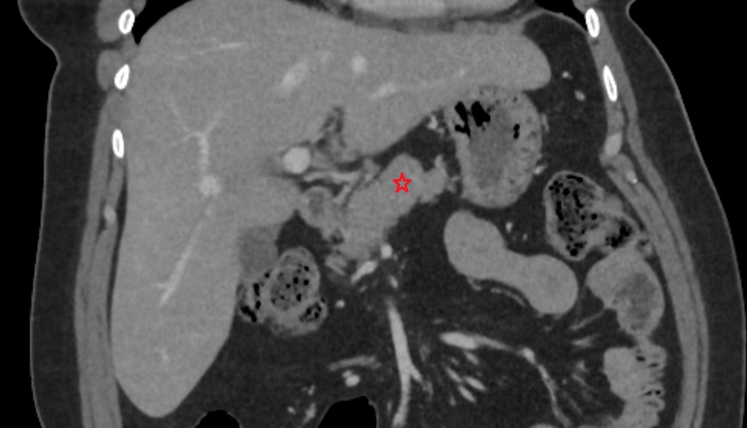 Body of pancreas  CT  coronal  anatomy image-img-00000-00000