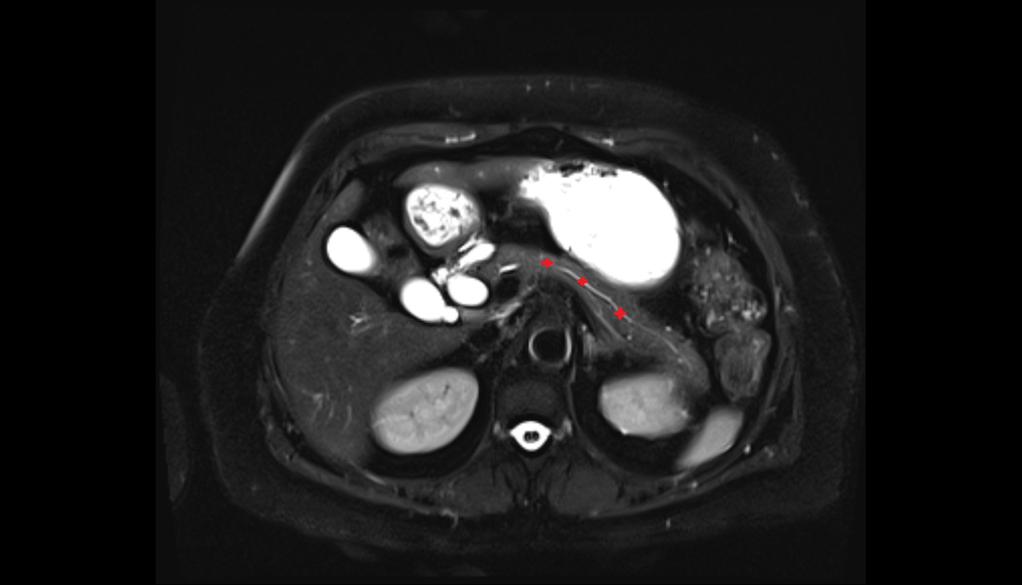 Body of pancreas  MRI axial  anatomy image-img-00000-00000