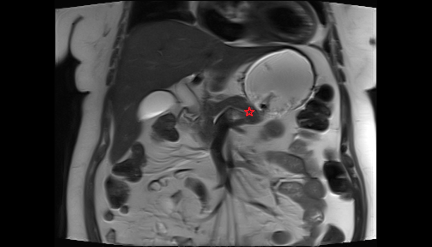 Body of pancreas  MRI coronal  anatomy image-img-00000-00000
